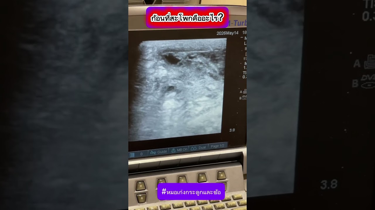 ก้อนที่สะโพกคืออะไร?