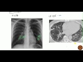 Bronchiectasis for USMLE