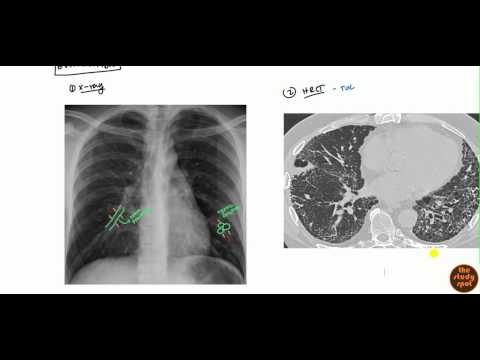 Video: Patogenesis, Pencitraan Dan Ciri-ciri Klinikal CF Dan Bronchiectasis Bukan CF