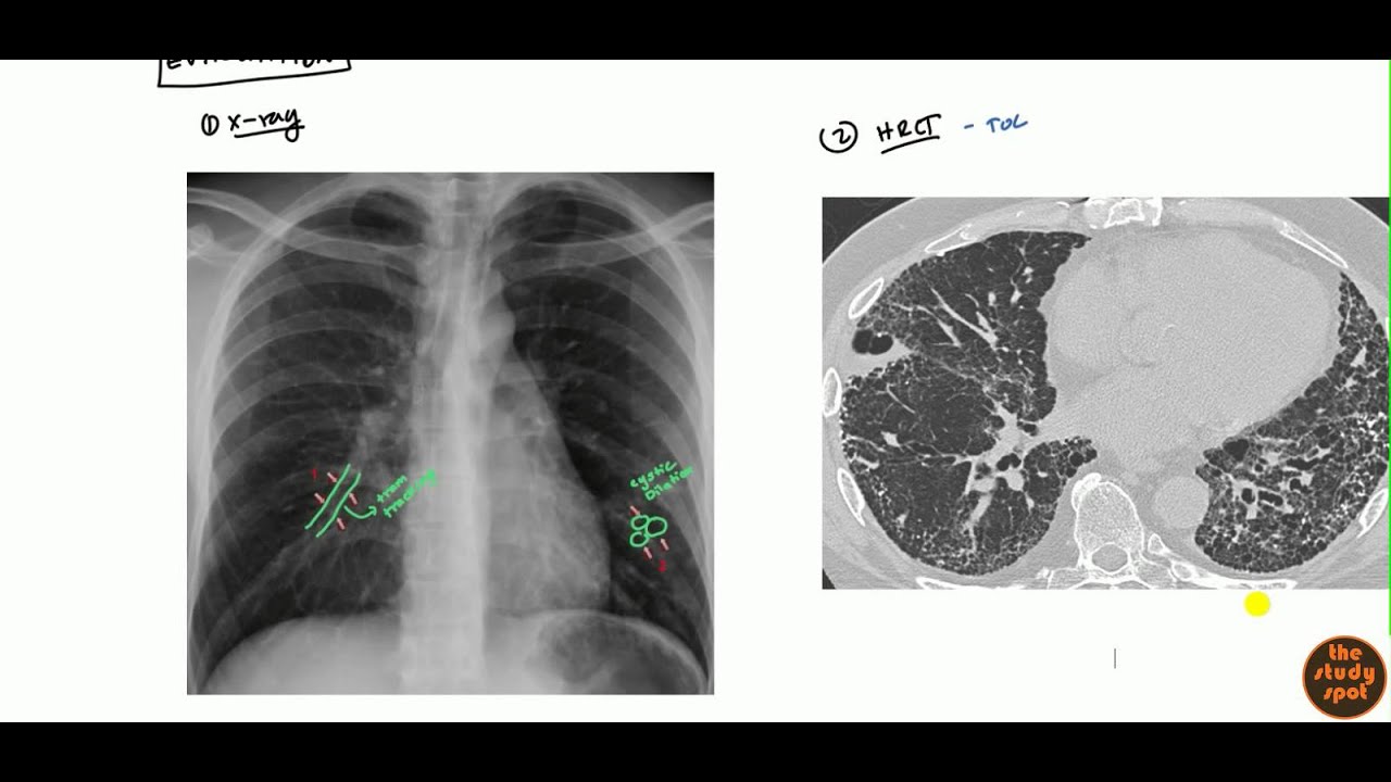 Surgical Management of Bronchiectasis | IntechOpen