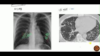 Bronchiectasis for USMLE