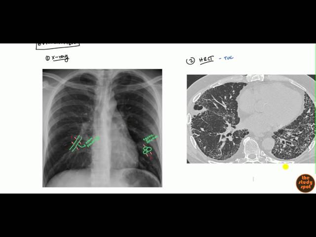Marks of a chronic lung disease - IMAGES FROM CLINICAL PRACTICE |  Universitatea de Stat de Medicină și Farmacie 