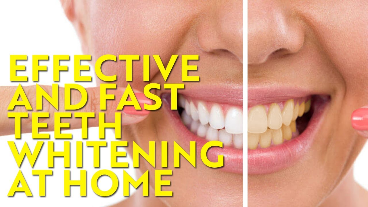 Natural Teeth Whiteners - Effective, Fast and Easy ...