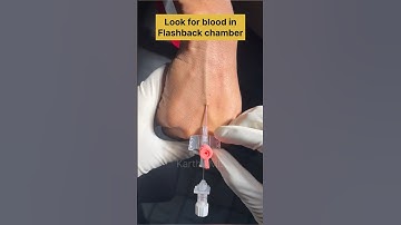 IV cannulation easy ! #anesthesia #doctor #anesthesiology #anaesthesia #anesthesiologist #nurse
