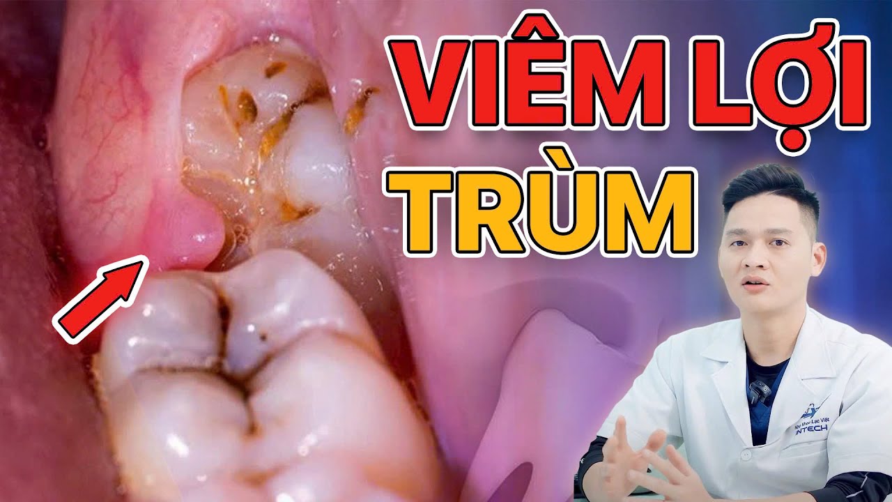 Outline Video Viêm Lợi Trùm Răng Khôn Có Tự Hết Được Không? Đây Là Cách Thoát Khỏi Cơn Đau Nhanh Nhất!
