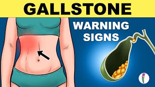 Gallbladder Stones Symptoms | Cholelithiasis | Gallstones Symptoms | Gallstones Warning Signs screenshot 2