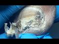 Black Onychomycosis Needs To Be Trimmed And Internal Water Stains Removed！