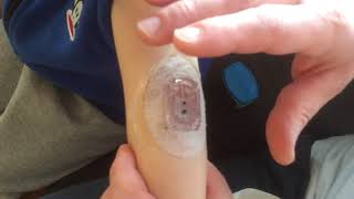 DEXCOM Sensor removal