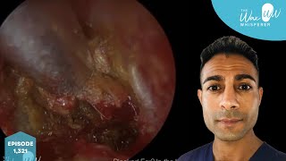 1,321 - Complex Grade III Keratosis Obturans Removal