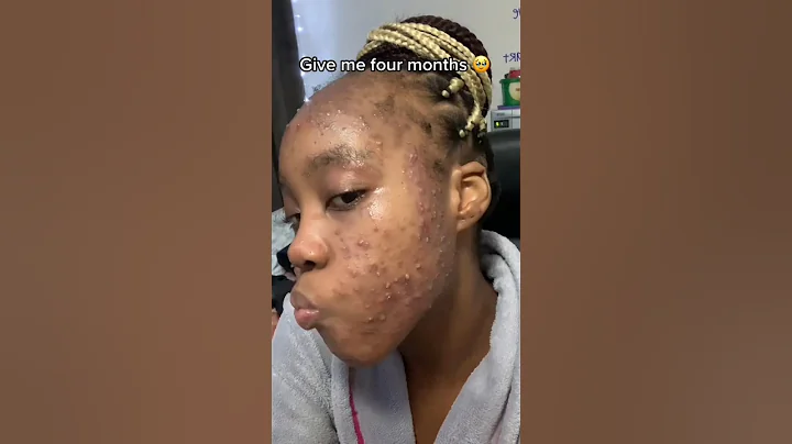 The 1 Thing That FINALLY Cleared My Skin😱 #acne #skincare #hyperpigmentation #acnescars #darkspots