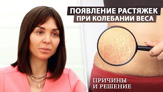 Растяжки: как они появляются и как их убрать?