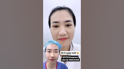 Cắt mí mắt sau 5 ngày #kangnam #catmi #catmimat #phauthuatthammy