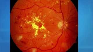 Diabetic Retinopathy