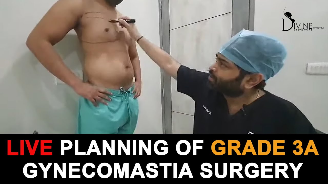 Live Planning Of Grade 3A Gynecomastia Surgery