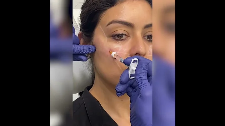 Cheek Filler w/ Alan, PA - AESTHETIC SKIN CHICAGO ...