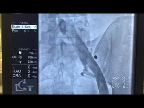 Флебография. Прямая ангиография.