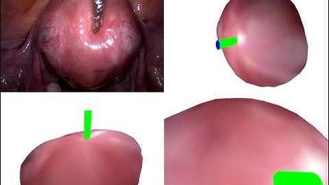 Template-Based Monocular 3D reconstruction of deformation