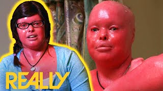 Living With Harlequin Skin — One Of The Rarest Skin Conditions In The World | Body Bizarre