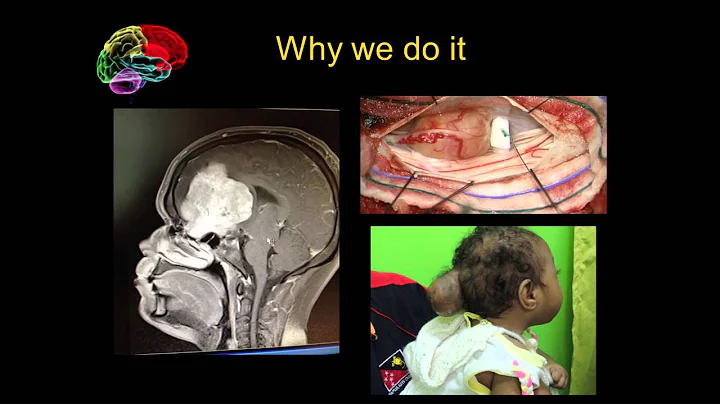 Why Brain Surgery | Dr Teresa Withers | TEDxStHild...