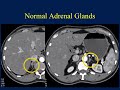 Ct of the adrenal mass a challenging diagnosis becomes even more difficult  part 1
