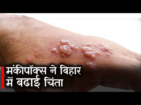 Monkeypox News : Monkeypox ने Bihar में  बढाई चिंता | Prabhat Khabar