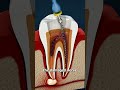 What Is A Root Canal? 😳