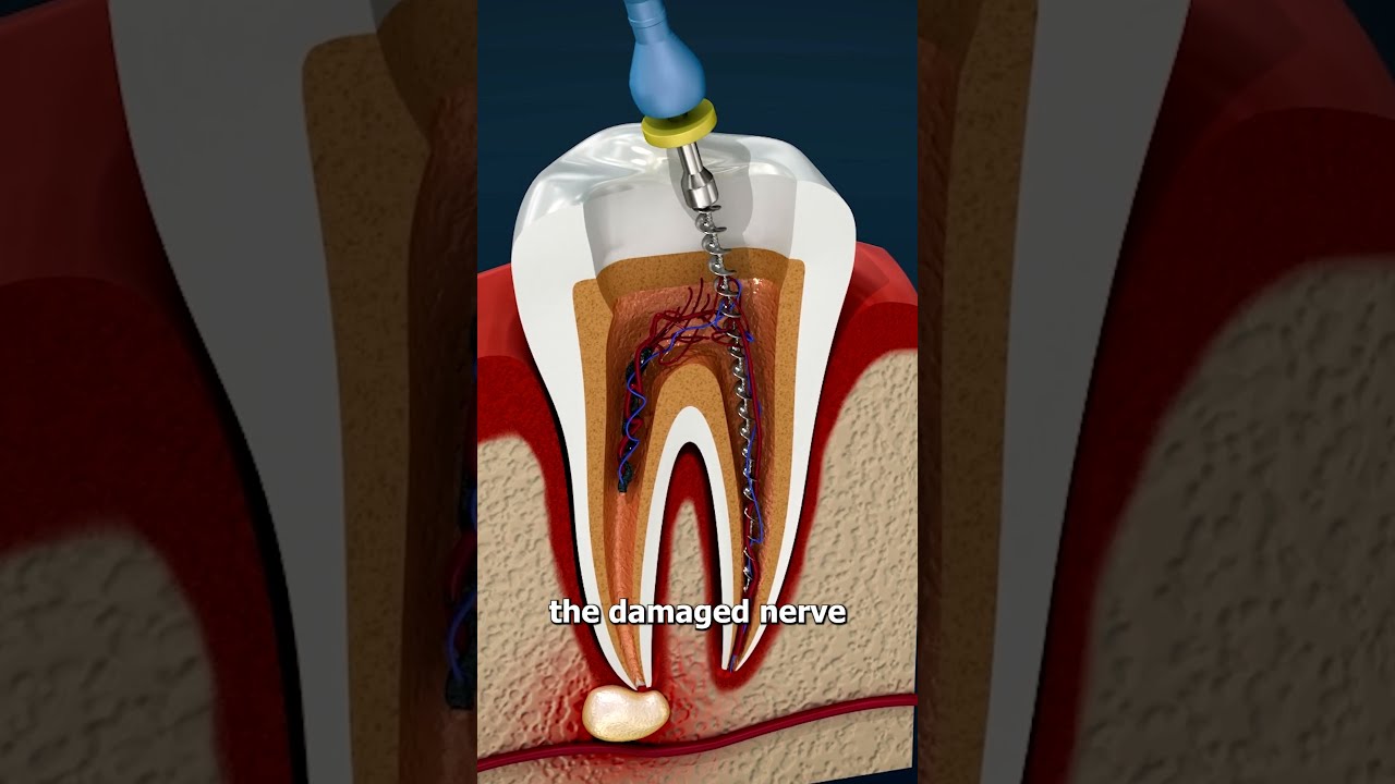 What Is A Root Canal 