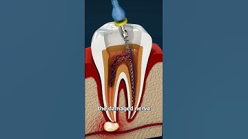 Thumbnail of What Is A Root Canal? 😳