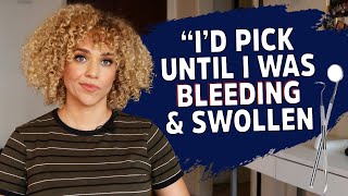 I Have A Compulsive Picking Disorder | Overcoming Dermatillomania | Storytime