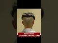35歳の若ハゲが植毛して1年で驚きの結果に...！