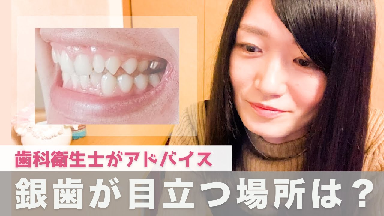 奥歯 銀 歯 目立つ
