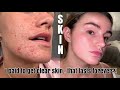 SKIN JOURNEY - I went on roaccutane, private health care, how much I paid.. | Syd and Ell