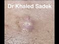 Infected cyst dr khaled sadek lipomacystcom
