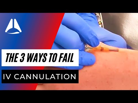 There are only 3 ways you can fail iv cannula insertion