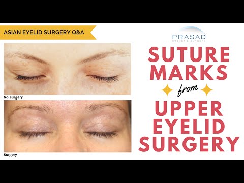 The Healing Process of Upper Eyelid Surgery, and How Suture Marks are Not Noticeable