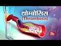 Ayushman Bhavah:  थ्रोम्बोसिस | Thrombosis
