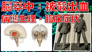 【大脳基底核】被殻出血の病態生理・臨床症状に関する知識を解説します！