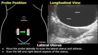 Uterus & Ovaries Ultrasound Probe Positioning | Transducer Placement | Gynecological USG Scanning