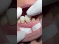 Distal class IV composite restoration for upper left canine tooth 🦷 #dentist #UK