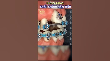 niềng răng hô, khấp khểnh như thế nào? #shorts #nhakhoa