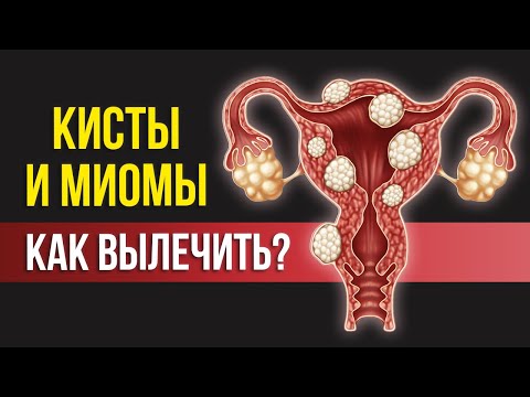 ЧТО СКРЫВАЕТ МЕДИЦИНА: почему образуются кисты и миомы и как их вылечить САМОСТОЯТЕЛЬНО?