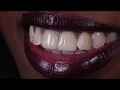 Porcelain fused to Zirconium crowns -  2 upper centrals