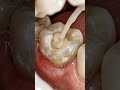 Cavity Filled Instantly 😱 Tooth Restoration Transformation #dentalcare #dentalrestoration