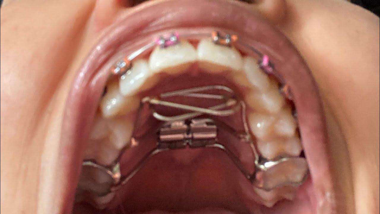 Braces Vlog Getting My Palatal Expander Appliance + Tongue Crib - YouTube