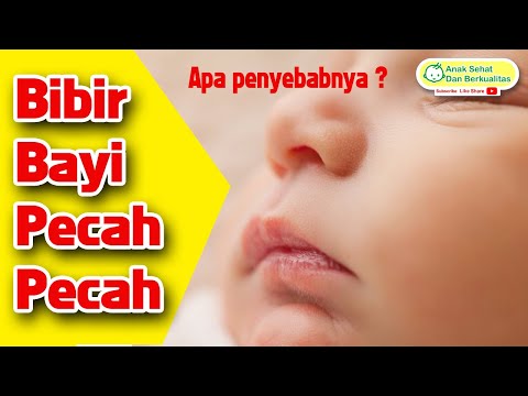 Video: Bibir Pecah Belah Baru Lahir: Cara Mencegah Dan Mengobati