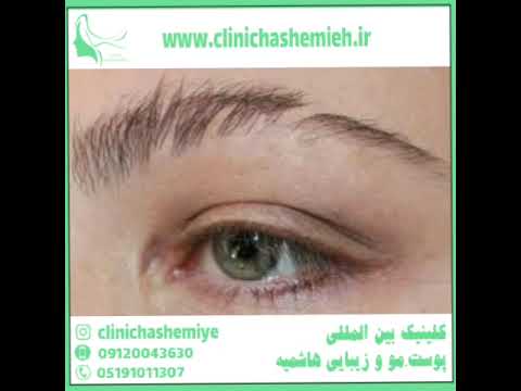 دلایل ریزش ابرو و راه های درمان آن