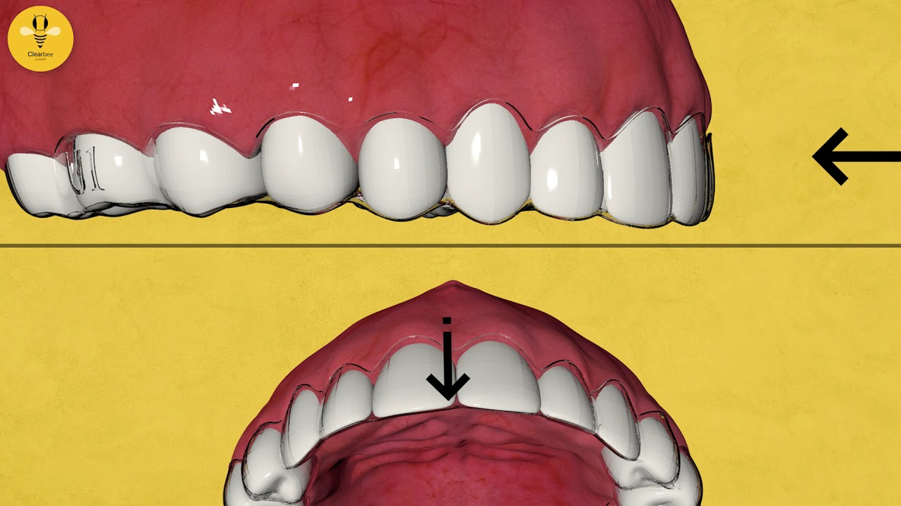 How to Straighten your Teeth without Metal Braces | Clearbee Aligner ...