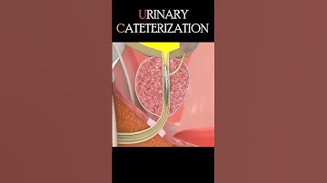 Thumbnail of Urinary Catheterization Procedure #shorts
