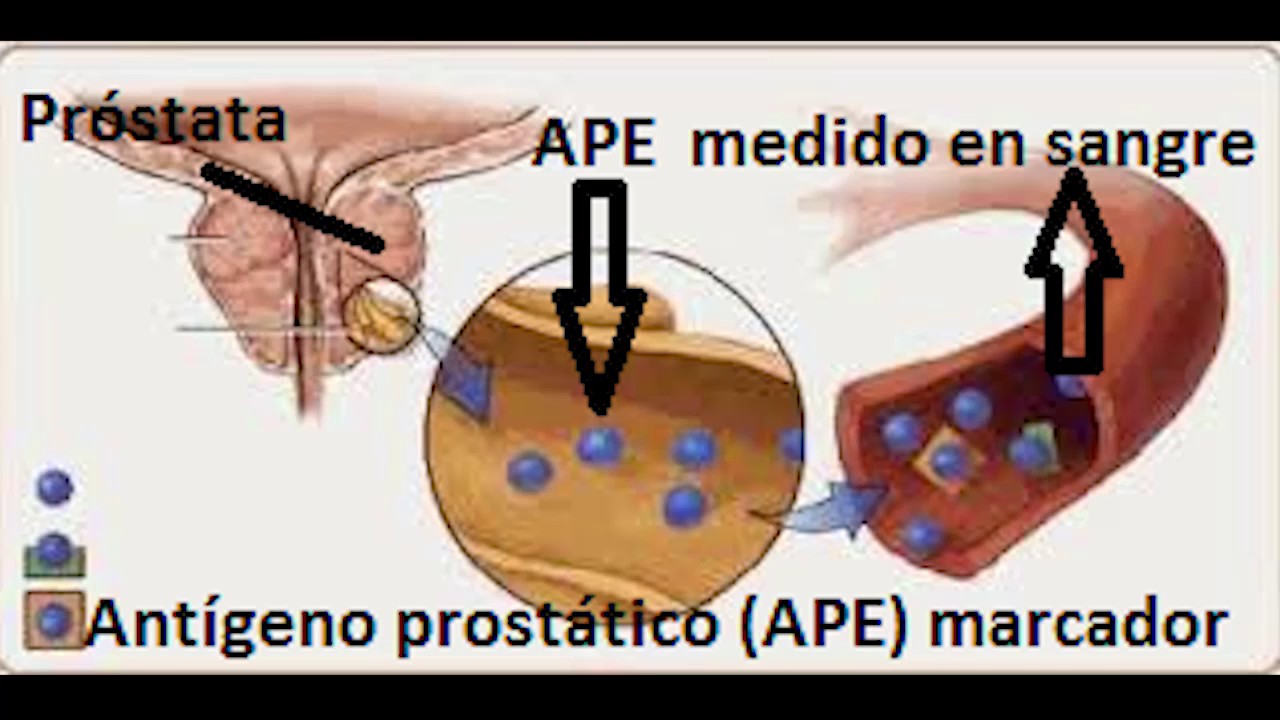 marcador de la próstata marcador de la próstata