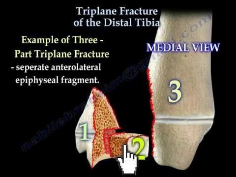 تصویری: چگونه شکستگی تریپلن را رفع کنیم؟